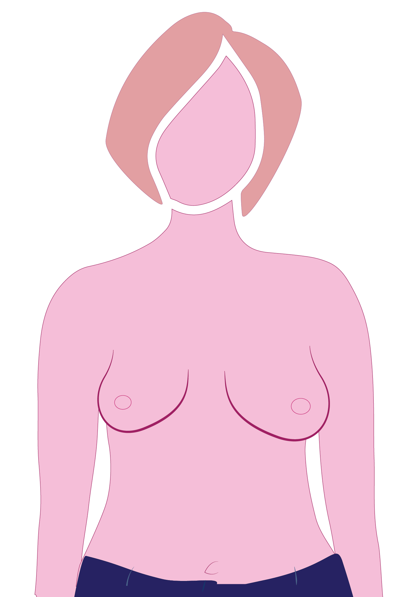 Breast Prosthesis, Custom Breast Prosthesis