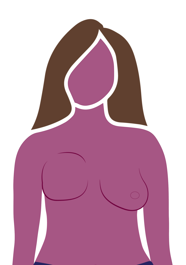 Custom Breast Prosthesis - American Breast Care